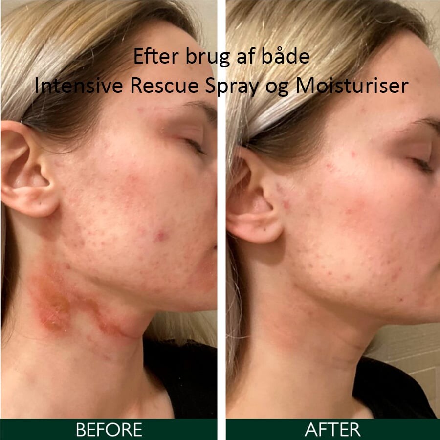 Sorted Skin - Intensive Rescue Spray 50 Ml